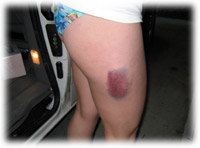 Anna's big bruise